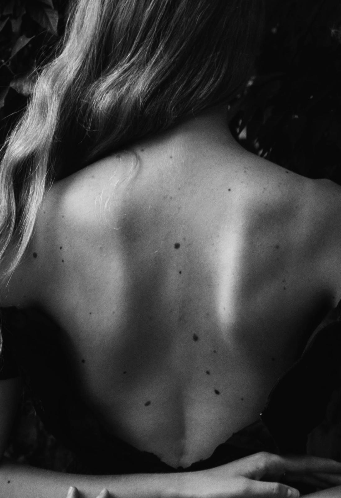 Mole Removal