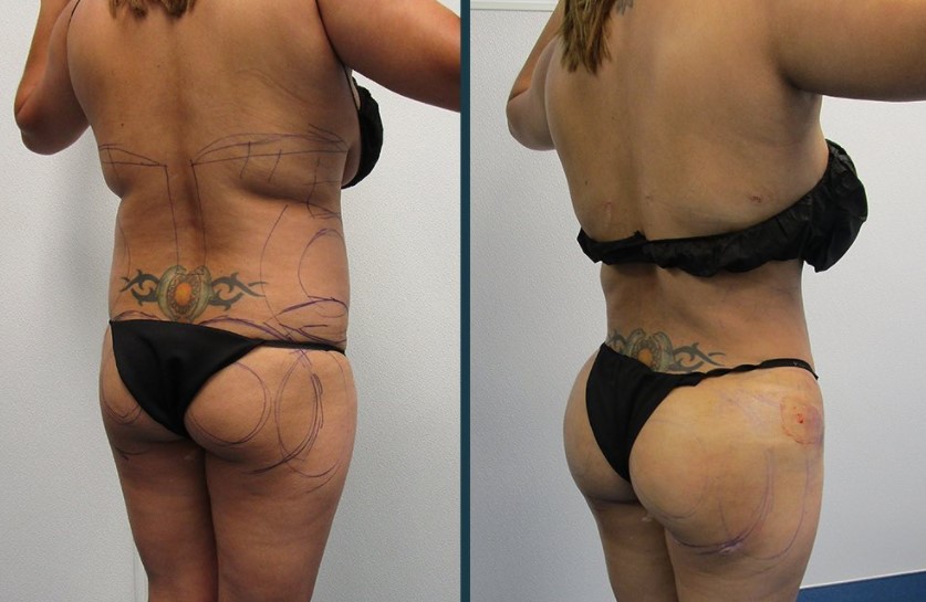 Buttock fat graft
