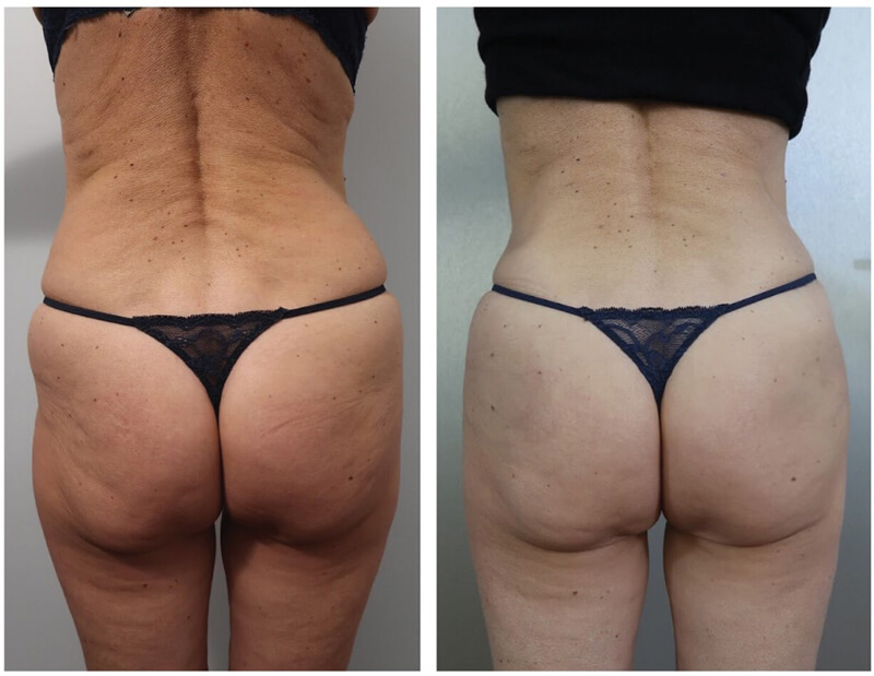 Buttock Fillers