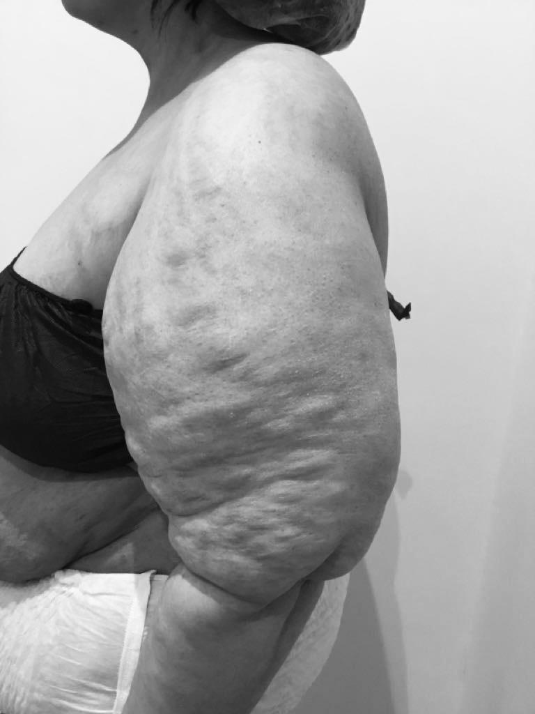 How Lipoedema and Vaser 4D Lipo Can Reshape Your Life