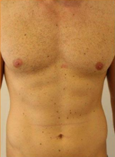 Gynaecomastia result 1