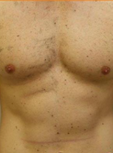 Before VASER Liposuction on Abdomen