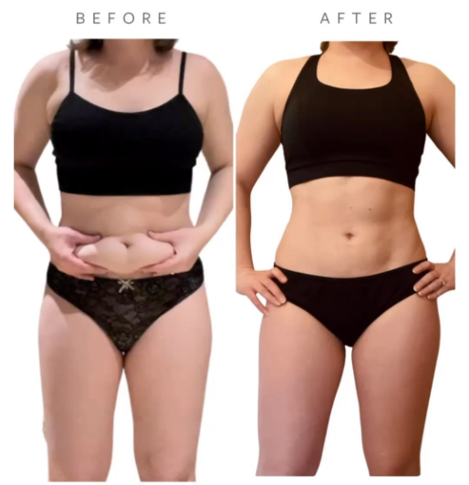 Before VASER Liposuction on Abdomen