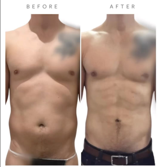 Before VASER Liposuction on Abdomen