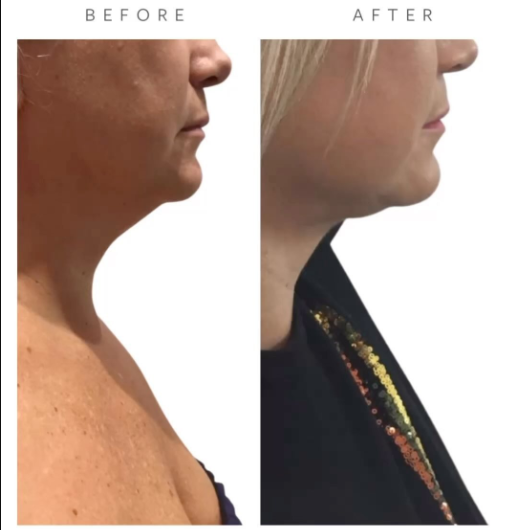 Before VASER Liposuction on Abdomen