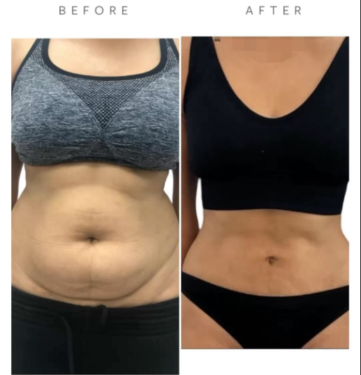 Before VASER Liposuction on Abdomen