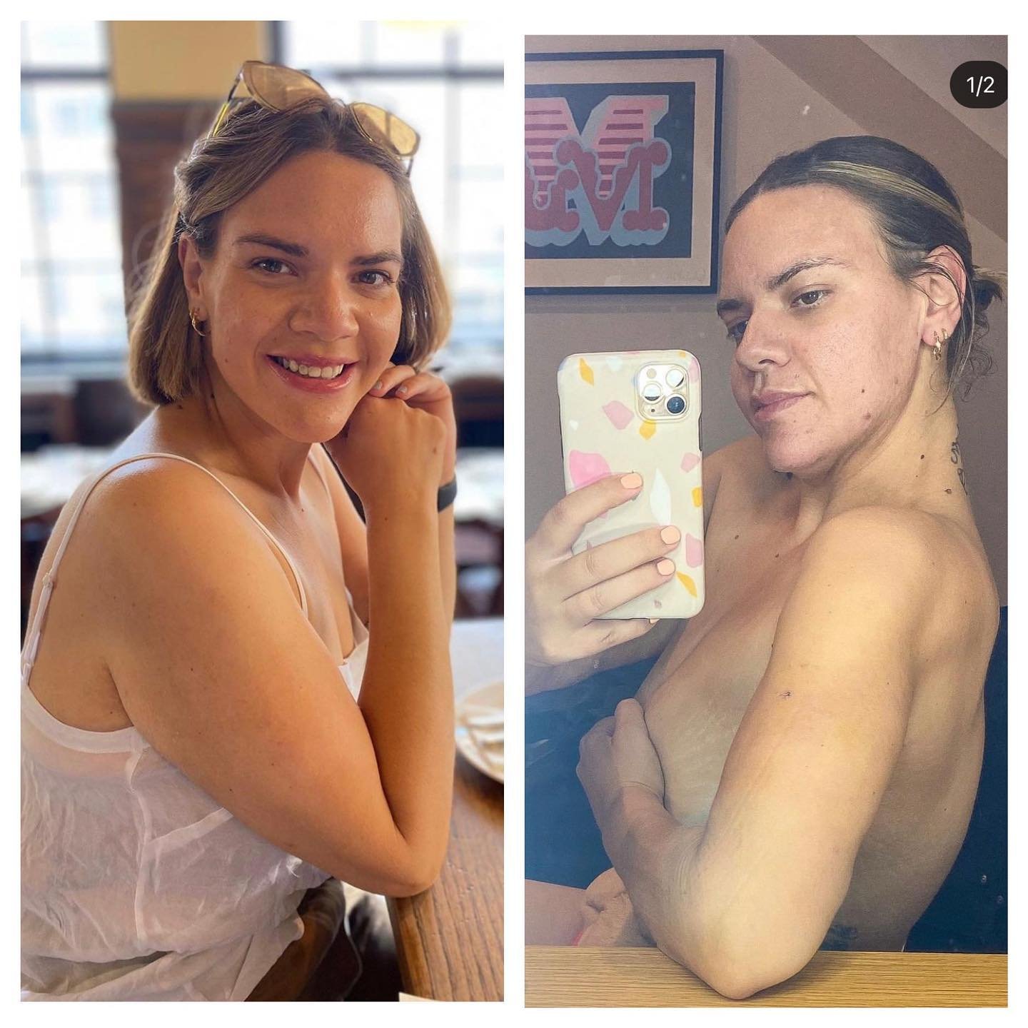 Before VASER Liposuction on Abdomen