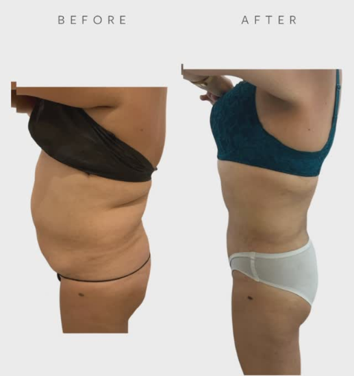 BodyTite Turbo before and after 1