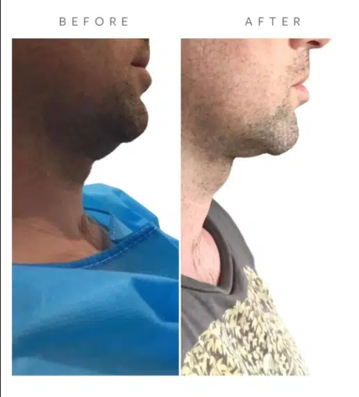 Before VASER Liposuction on Abdomen
