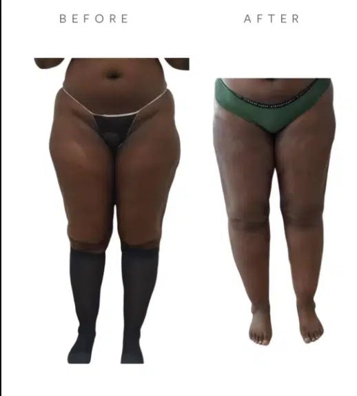 Before VASER Liposuction on Abdomen