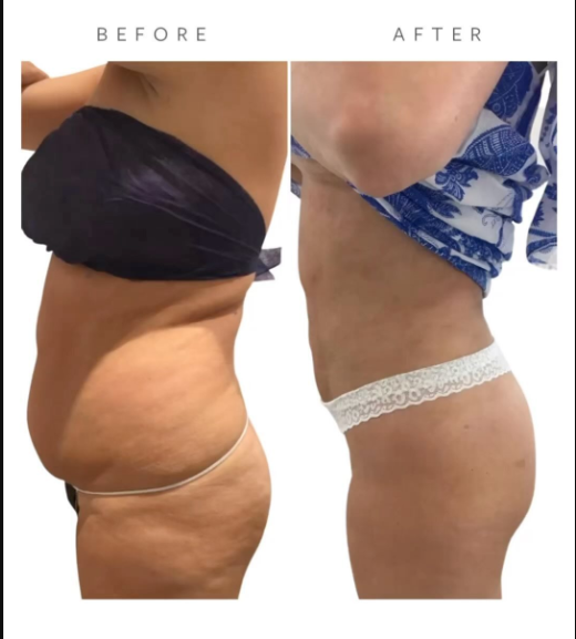 Before VASER Liposuction on Abdomen