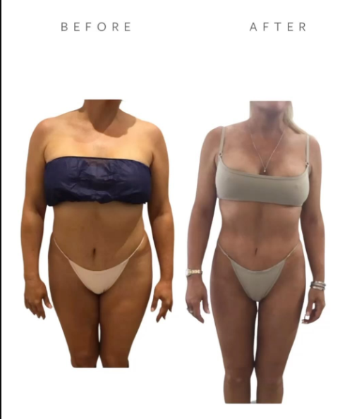 Before VASER Liposuction on Abdomen