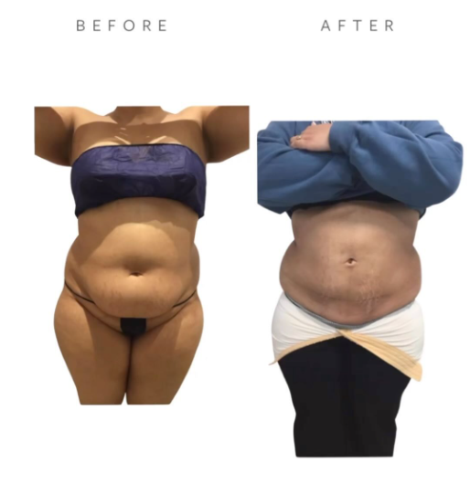 Before VASER Liposuction on Abdomen